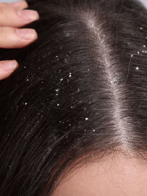 Dandruff & Hair Fall Treatment Service at SRB Makeovers West Delhi